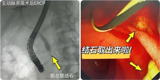 Beijing Anzhen Hospital Advances Minimally Invasive Digestive Treatment with Successful Painless ERCP Procedures