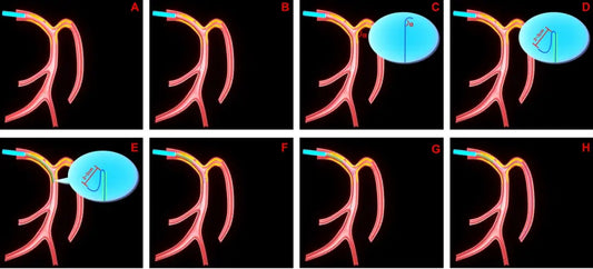 🌍 Global Debut! Fuwai Hospital’s Innovative RWT Technique Published in Top International Journal: Redefining Standards for "Extreme-Angled" Coronary Interventions