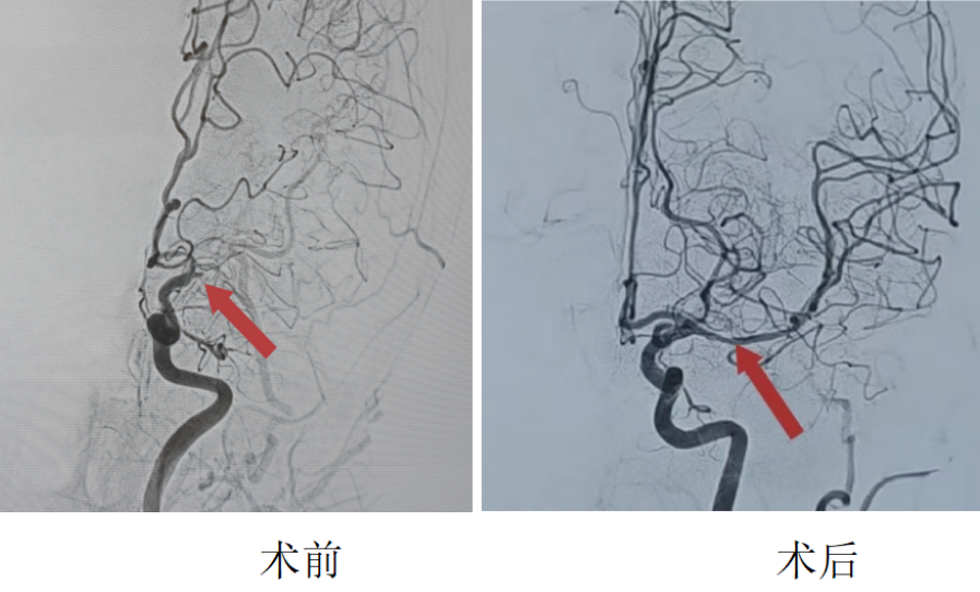 Managing Medically Refractory Acute Stroke: Clinical Decision Logic for Combined Thrombectomy and Stenting