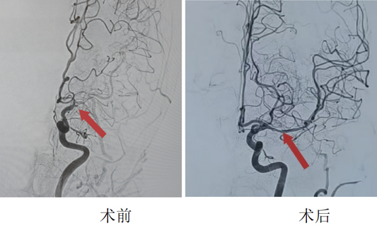 Managing Medically Refractory Acute Stroke: Clinical Decision Logic for Combined Thrombectomy and Stenting