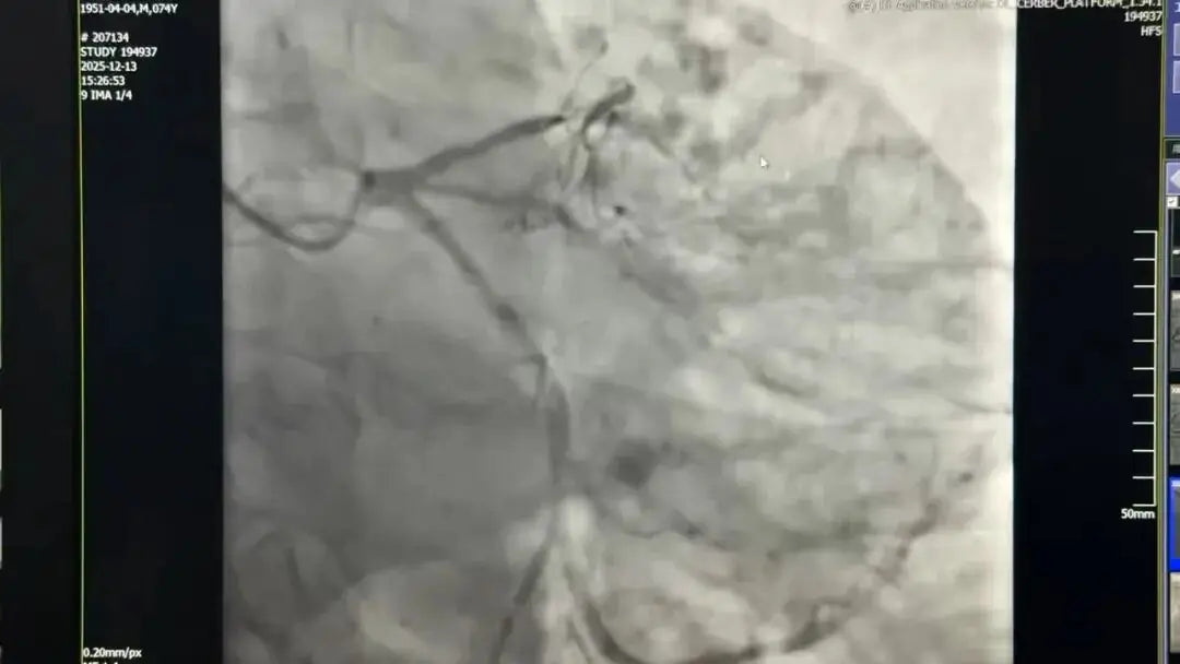 Fu Wai Hospital Uses Atherectomy and Stenting to Open CTO with Severe Calcification in 74-Year-Old Patient