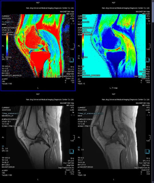 From Morphology to Composition: Beijing Radiology Team Achieves Pixel-Level "Biochemical Auditing" of Cartilage via $T_{2}$-Mapping.