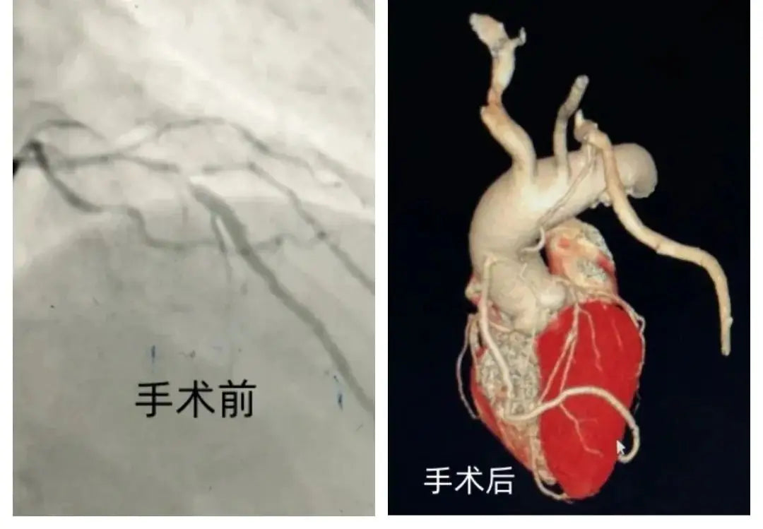 Minimally Invasive Coronary Bypass Surgery: A Revolutionary Approach to Faster Recovery