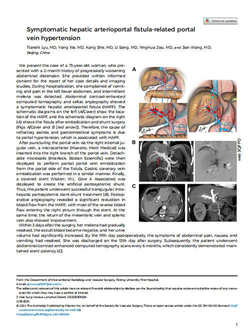 5-Year Milestone: PKU First Hospital’s World-First "Block-and-Drain" Tech Defies Vascular Limits