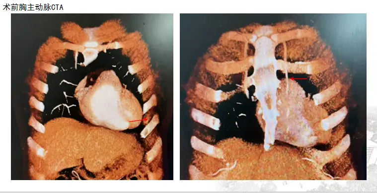 Fuwai Hospital Successfully Demonstrates Minimally Invasive Coronary Artery Bypass Surgery