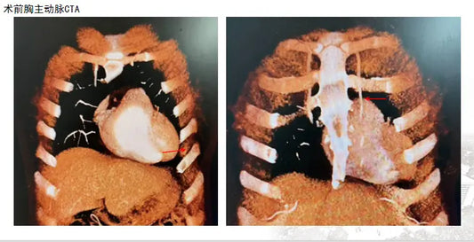 Fuwai Hospital Successfully Demonstrates Minimally Invasive Coronary Artery Bypass Surgery