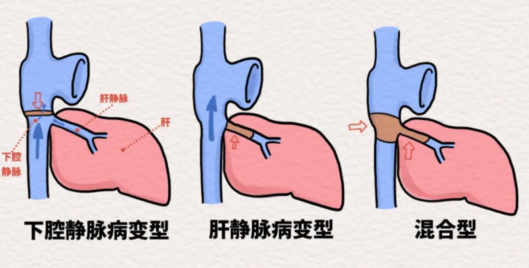 [Technical Frontiers] IVC Recanalization for Budd-Chiari Syndrome at Peking University People's Hospital