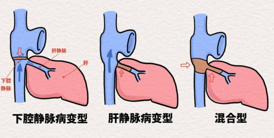 [Technical Frontiers] IVC Recanalization for Budd-Chiari Syndrome at Peking University People's Hospital