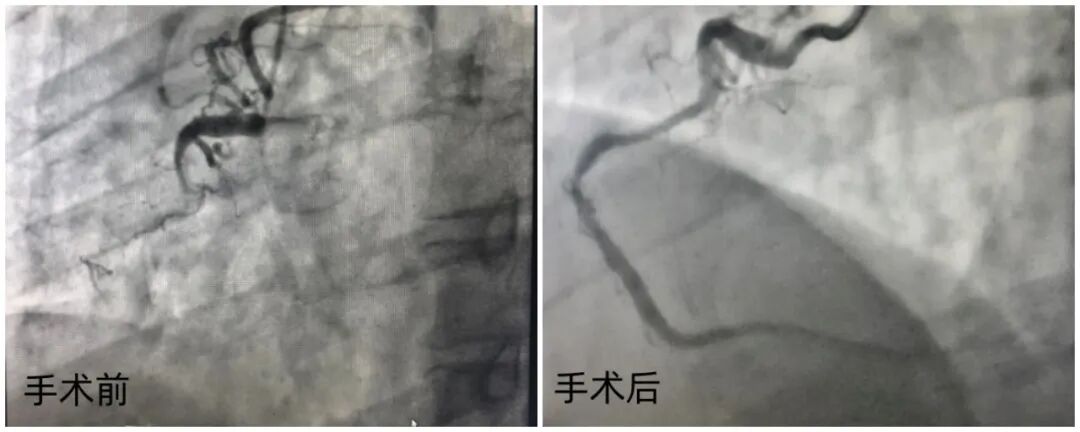 Technical Standards: Clinical Decision Pathways for "Intervention Without Implantation" in Complex Angulated CTOs