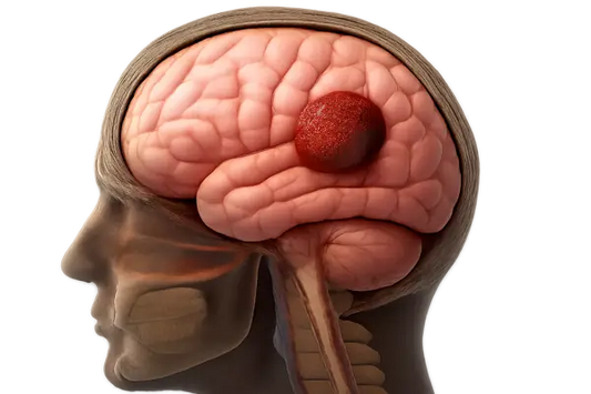 Understanding Gliomas: Symptoms, Diagnosis, and Treatment Options