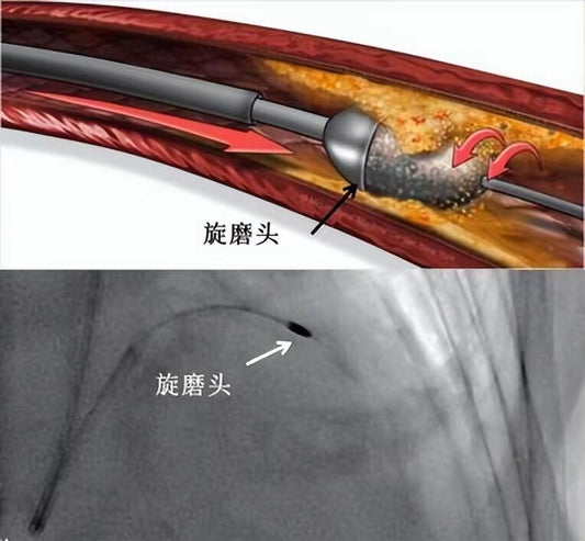Precision Intervention for Complex Calcified Lesions: Technical SOP Analysis from Fuwai Hospital Beijing