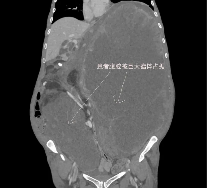 🏥Life Within a 17.5kg Tumor: A Deep Dive into Surgical Decision Logic