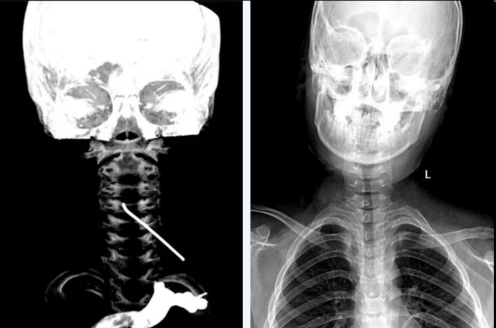 PUMCH Extraction of a 10cm Hooked Foreign Body in the Cervical Canal