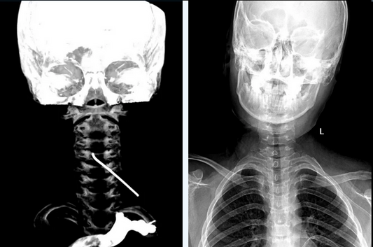 PUMCH Extraction of a 10cm Hooked Foreign Body in the Cervical Canal